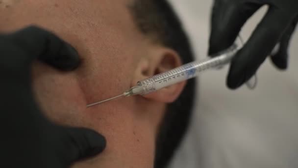 接近中だ 男性の顔の皮膚の下に注射用の注射針でシリンジ 締め付け手順 白人の問題だ 美容師黒手袋 — ストック動画