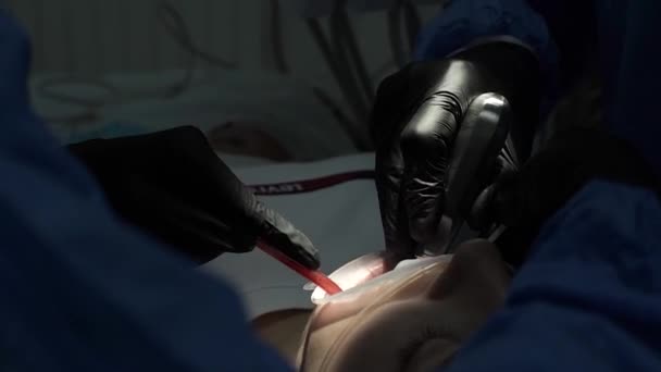 Tandarts Zwarte Handschoenen Verwijdert Een Patiënt Tand Met Een Medische — Stockvideo