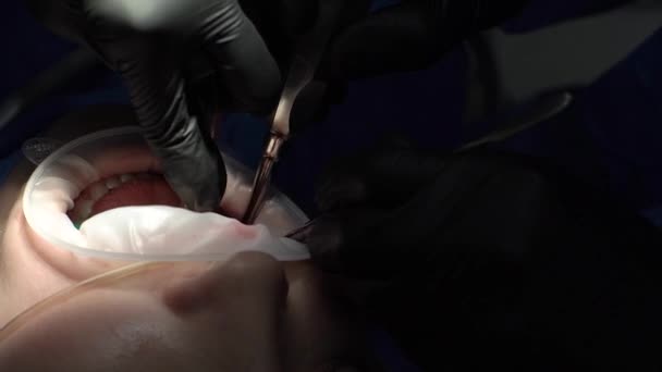 Chirurg Černých Rukavicích Používá Špičku Pro Zubní Implantaci Asistent Sbírá — Stock video