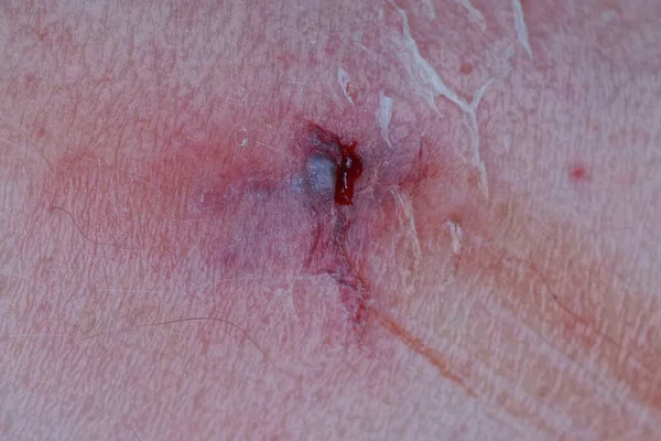 Jedno Małe Zadrapanie Czerwoną Krwią Białej Skórze Nogi — Zdjęcie stockowe