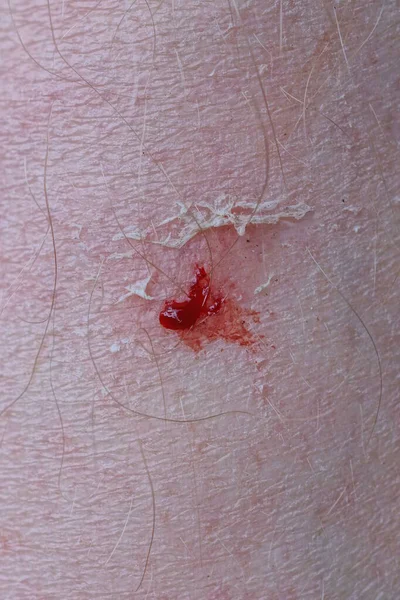 one small wound scratch with red blood on the white skin on the leg