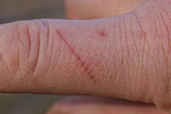 red wound cut on the skin of a finger on a person\'s hand