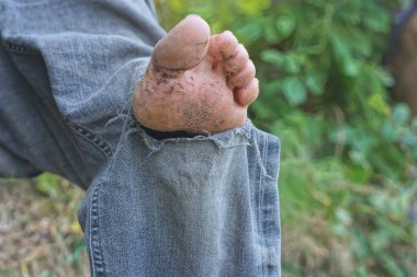 Delikten çıkmış ayak parmakları olan bir adam. Sokakta mavi yırtık kot pantolon paçası.