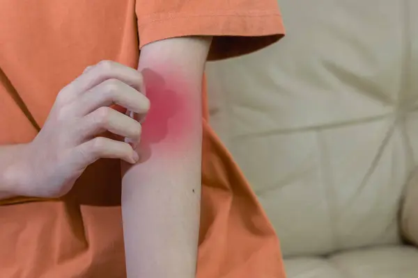 Anak Muda Menggaruk Gatal Lengannya Kulit Merah Ruam Alergi Kulit Stok Gambar