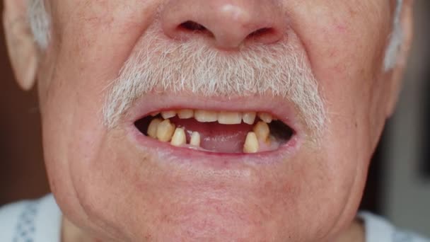 Κοντινές Μακρο Φωτογραφίες Του Ξεδοντιάρικου Ανδρικού Χαμόγελου Ηλικιωμένου Άνδρα Οδοντικό — Αρχείο Βίντεο