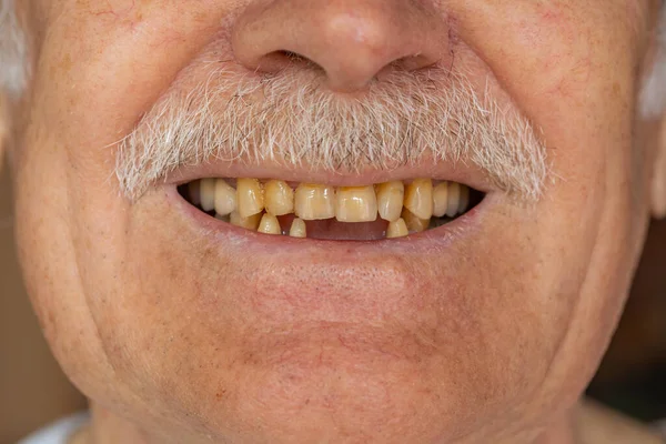 Macro Scatto Ravvicinato Sdentato Sorriso Maschile Bocca Anziano Anziano Problemi — Foto Stock