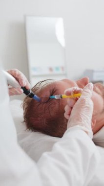 Alopecia. İnsan saçı kaybı büyüme tedavisini arttırır dermapen mikronedling, vitamin eksozları plazma serumu enjeksiyonları. Trichologist doktor kafa derisi prosedürü Kısmi mezoterapi.