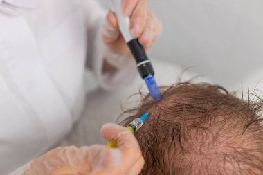 Alopecia. Erkek saçı kaybı büyüme tedavisini, dermapen mikronedling 'i, vitamin egzomları plazma serumu enjeksiyonlarını iyileştirir. Trichologist doktor kafa derisi prosedürü Kısmi mezoterapi