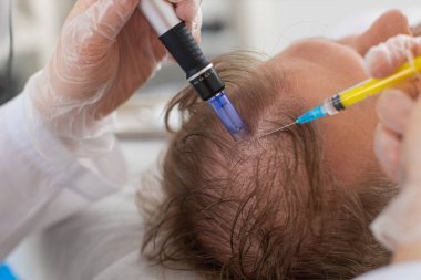 Alopecia. Erkek saçı kaybı büyüme tedavisini, dermapen mikronedling 'i, vitamin egzomu plazma enjeksiyonlarını geliştirir. Trikoloğum doktor kafa derisi yüzme prosedürü kısmi mezoterapi