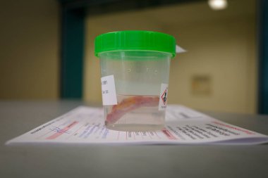 Alınan bir apandis formalin dolu bir diseksiyon kabına konur.