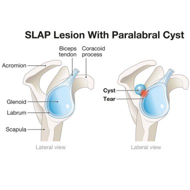 A SLAP lesion paralabral cyst in the shoulder is a tear in the labrum accompanied by a cyst, often causing pain, instability, and functional limitations, typically requiring surgical intervention for treatment. clipart
