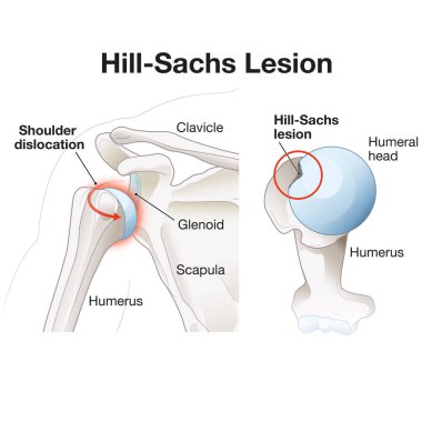 Hill-Sachs lezyonu, genelde omuz çıkığından kaynaklanan humeral baştaki çukura benzer bir bozukluktur. Birleşmedeki istikrarsızlığa ve sınırlı hareket aralığına katkıda bulunabilir..