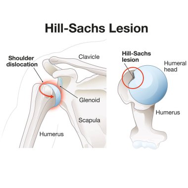 A Hill-Sachs lesion is a divot-like defect on the humeral head, often resulting from shoulder dislocation. It can contribute to instability and limited range of motion in the joint. clipart