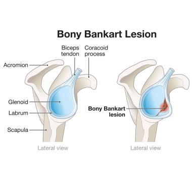 A Bony Bankart lesion in the shoulder involves a fracture of the anterior glenoid rim, often resulting from dislocation, leading to instability and requiring surgical repair for stability restoration. clipart