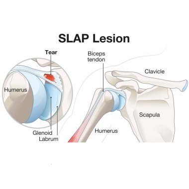 A SLAP lesion in the shoulder refers to an injury to the superior labrum, often caused by trauma or overuse, resulting in pain, instability, and reduced shoulder function. Treatment may involve arthroscopy or rehabilitation. clipart