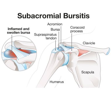 Subacromial bursitis is inflammation of the bursa in the shoulder, causing pain, swelling, and reduced mobility, often associated with rotator cuff issues or overuse injuries. clipart