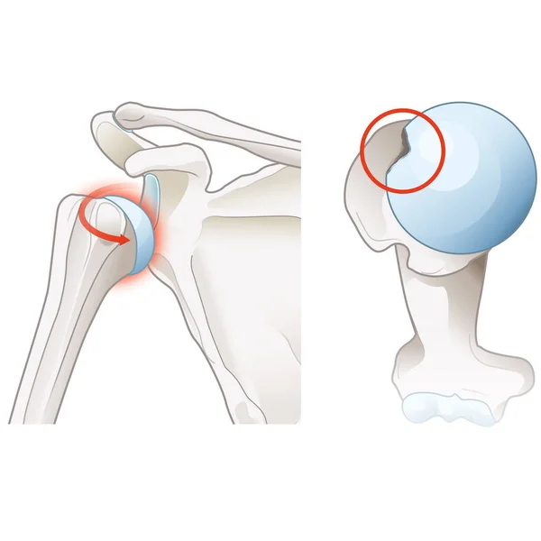 Subacromial Bursitis Inflammation Bursa Shoulder Causing Pain Swelling Reduced Mobility — Stock Photo, Image