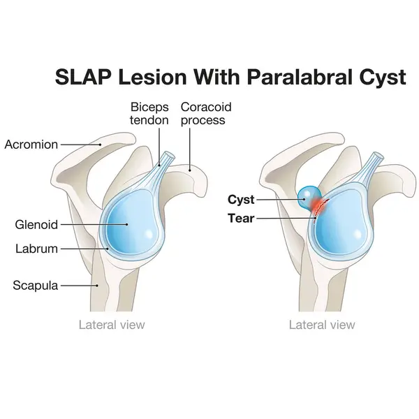 Slap Lesion Paralabral Cyst Shoulder Tear Labrum Accompanied Cyst Often — Stock Photo, Image