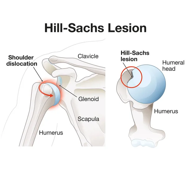 Hill Sachs Lesion Divot Defect Humeral Head Often Resulting Shoulder — Stock Photo, Image