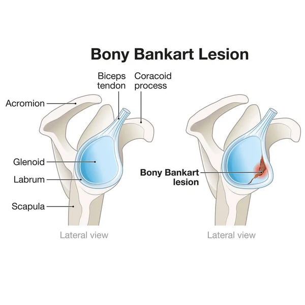 Bony Bankart Lesion Shoulder Involves Fracture Anterior Glenoid Rim Often — Stock Photo, Image