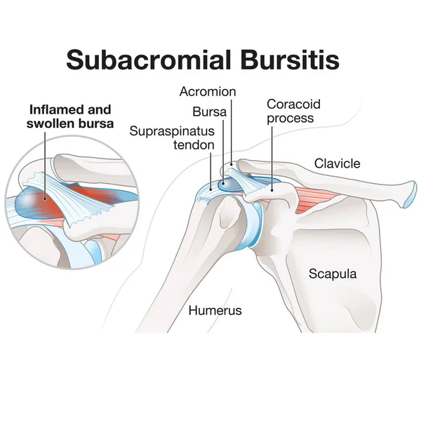Subacromial Bursitis Inflammation Bursa Shoulder Causing Pain Swelling Reduced Mobility — Stock Photo, Image