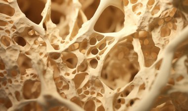 Kemik yapısında osteoporoz. D vitamini eksikliği, kırıklar, östrojen