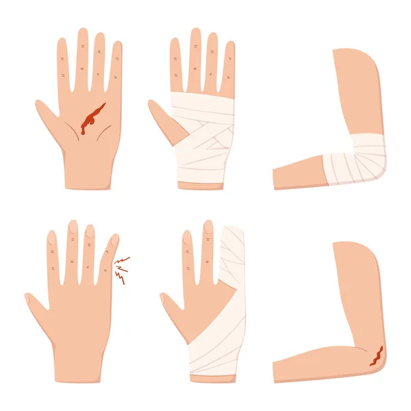 一组手部 手指和手臂受伤 有血迹和绷带 在白色背景下隔离 采购产品急救 肢体创伤治疗 康复概念 卡通矢量图解 — 图库矢量图片