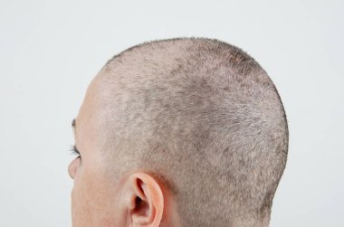 Bu görüntü bir kadının sol tarafını yakalıyor, hafifçe çevrilmiş, çok kısa saçlar ve belirgin kel yamalar gösteriyor. Kemoterapi 25 gün önce başladı ve parlak, hatta aydınlatma bile seyrek saç ve pembemsi kafa derisini vurguluyor..