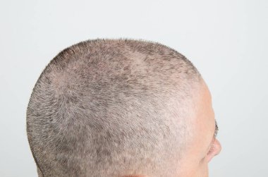 Cesur Yolculuk: Kadınların Saç Kaybı Yolculuğu 25 Gün Kemoterapiye Girme, Kanser Tedavisinin Yüzündeki Gücü Gösterme