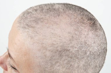 Kemoterapiden 25 Gün Sonra: Bir Kadının Kafasının Yakın Çekimi Kel ve Kel Noktalarını Gözden Geçiriyor, Tedavinin Fiziksel Etkisini Gösteriyor