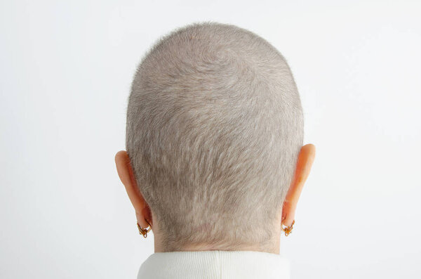Renewal: Delicate Hair Growth 70 Days Post-Chemotherapy Highlights Recovery Process in Medical Photograph.