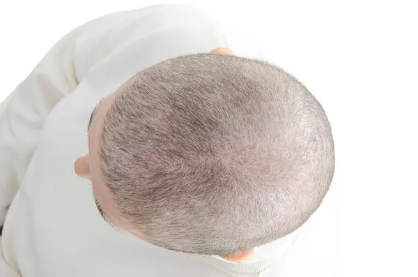 stock image Regrowth Journey: Overhead View Highlights New Hair Growth 70 Days Post-Chemotherapy in 62-Year-Old Woman.