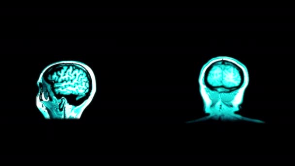 Imágenes Resonancia Magnética Cabeza Rayos Cerebrales Sobre Fondo Negro — Vídeos de Stock
