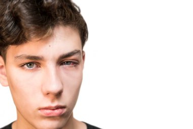 Acı çeken bir yüzü ve beyaz bir geçmişi olan genç bir çocuk. Ergen, konjonktivit hastası olduğu için acı çekiyor.