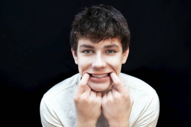 Genç ve güzel bir çocuğun dişlerinde diş telleri. Adam gülümsüyor ve diş telleri dişlerinde açıkça görülüyor. Diş Konsepti