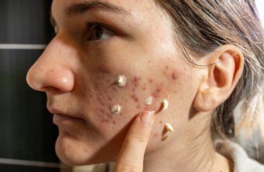 Genç bayan aynaya yakından bakıyor. Sivilceli hassas cilde krem sürüyor.