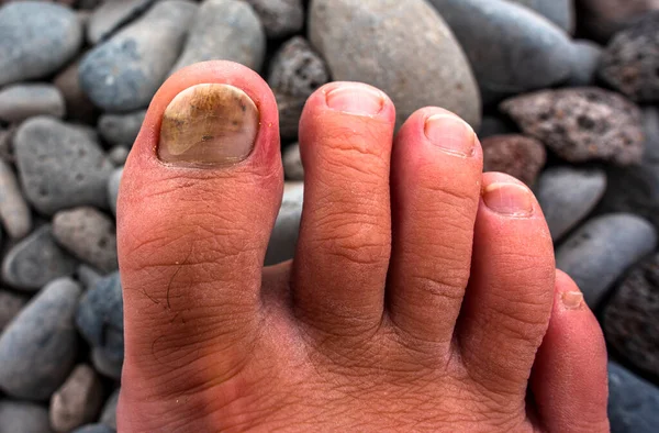 right big toe nail blackened by a crush and by the tight shoes of a foot path of an adult man with volcanic stones background