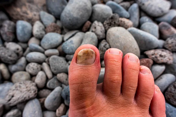right big toe nail blackened by a crush and by the tight shoes of a foot path of an adult man with volcanic stones background