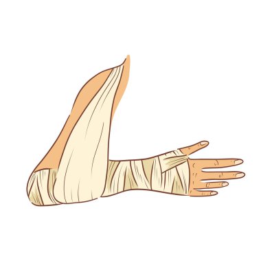 Düz dizayn destekli sargılı bir el. Bandaj alçıtaşıyla kırık kol. Vektör çizimi izole edildi.