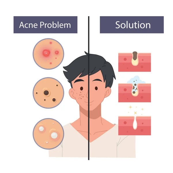 男性面部护理的概念 面部护理 皮肤缺陷 皮肤问题 面部护理 面部护理图标 — 图库矢量图片