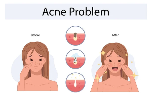 面部皮肤有问题的女人很不安粉刺疾病的信息和治疗阶段 之前和之后 矢量说明 — 图库矢量图片
