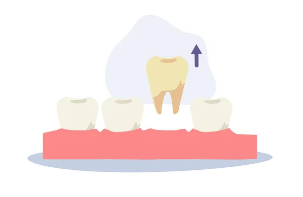 Concepto Médico Dental Extracción Dental Dibujos Animados Planos Vector Ilustración — Vector de stock