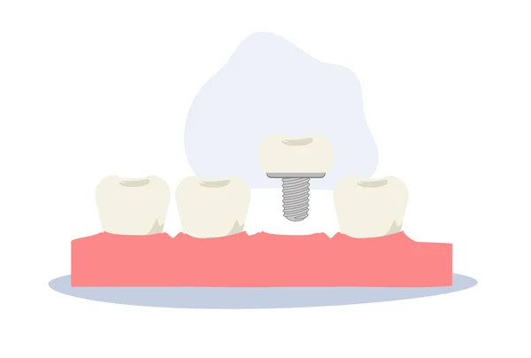 Tandläkarvård Tandimplantat Tandimplantat Platt Tecknad Vektor Illustration — Stock vektor