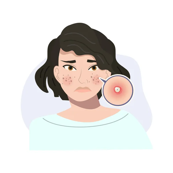Retrato Mujer Estresada Con Piel Problemática Acné Pustule Skin Close — Vector de stock