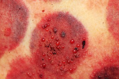 Deri hastalığı, birden fazla uçuk, fotoğrafa yakın çekim.