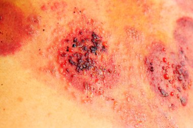 Deri hastalığı, birden fazla uçuk, fotoğrafa yakın çekim.