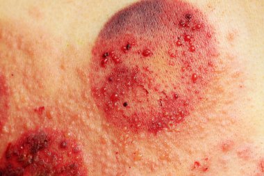 Deri hastalığı, birden fazla uçuk, fotoğrafa yakın çekim.