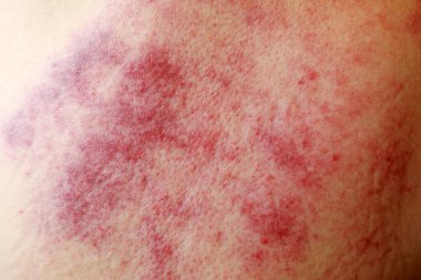 Red patches on the back skin after scraping