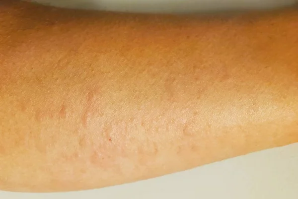 Close Itchy Arm Flaring Hives — Stock Photo, Image