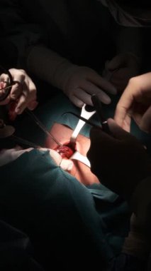 Tiroid bezi ameliyatı yaparken özel aletler kullanan isimsiz cerrahlar ameliyathanede ameliyat yaparlar. Dikey yönelim